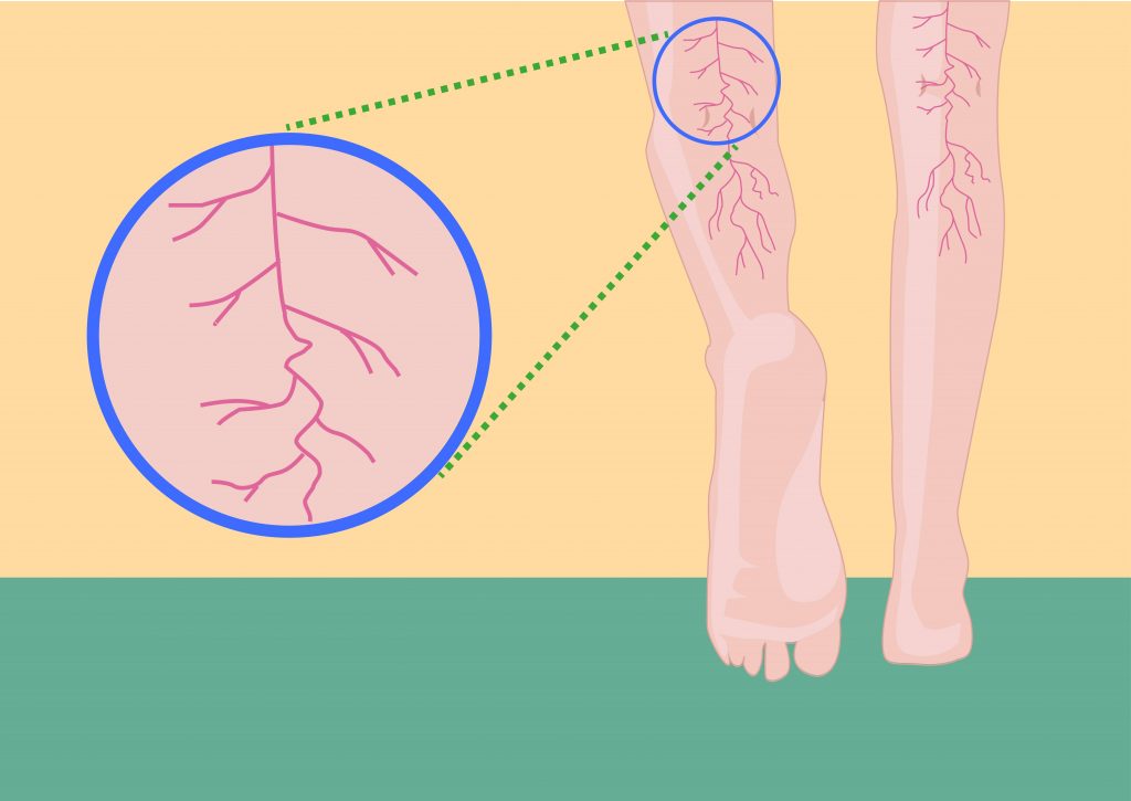 Ból nóg - rodzaje, przyczyny i leczenie- Żylaki - grafika