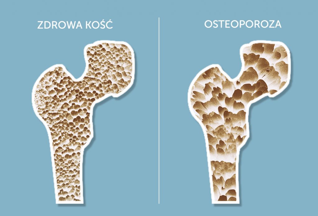 osteoporoza co to umflarea în articulația genunchiului cum să se trateze