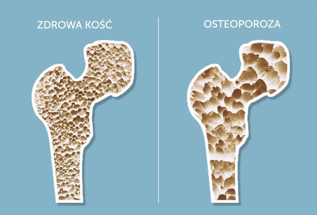 Osteoporoza