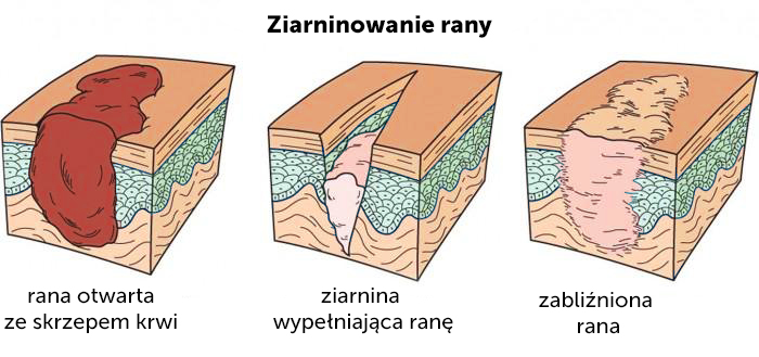 Owrzodzenia i rany 