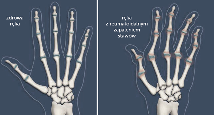 Kościec zdrowy dłoni i z deformacjami w wyniku RZS