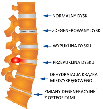 Przyczyna bólu kręgosłupa - degeneracja krążków międzykręgowych