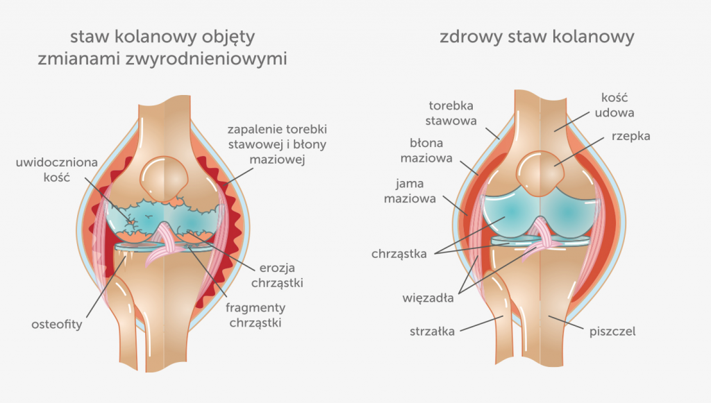 Zwyrodnienie stawu kolanowego - ból kolana