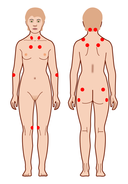 Ból z tyłu głowy - Punkty bolesne - diagnostyka fibromialgii